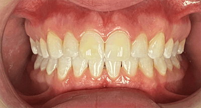 Close up of mouth after white spots have been removed from teeth