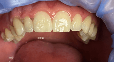 Close up of mouth after white spot removal on multiple teeth