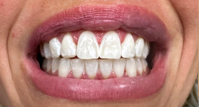 Close up of mouth after white spot removal on multiple teeth