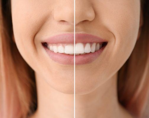 Split view of woman with gummy smile before gum recontouring and even gumline afterward