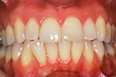 Close up of misaligned teeth