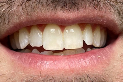 Close of man smiling after white spot removal on his front teeth