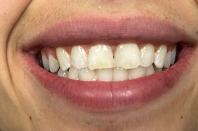 Close up of smile after white spots on two front teeth were removed