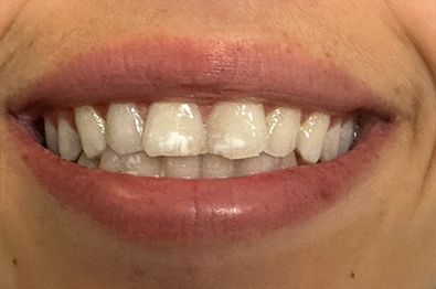 Close up of smile with white spots on two front teeth