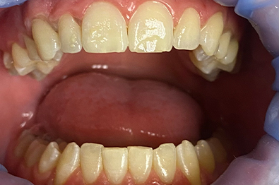 Close up of mouth after white spot treatment on two front teeth