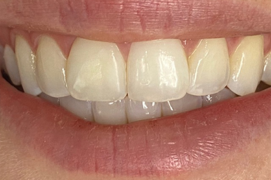 Close up of two front teeth with no white spots