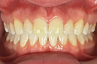 Close up of mouth after white spots were removed from several teeth
