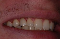 Close up of mouth with missing tooth replaced by dental implant in Brookline