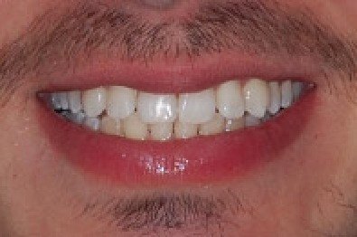 Close up of smile with evenly aligned teeth