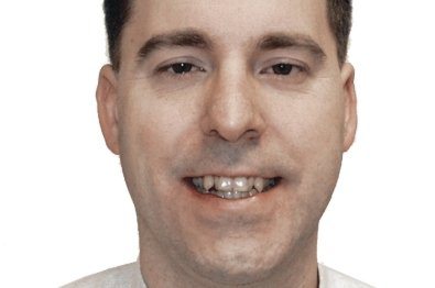 Close up of man with misaligned teeth