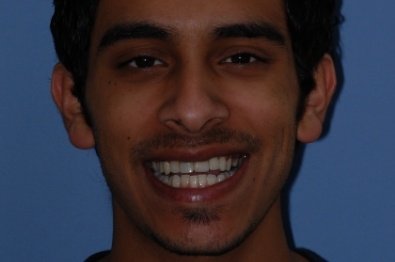 Close up of smiling young man with slightly misaligned teeth