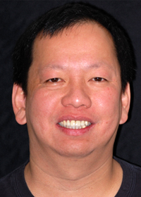 teeth whitening 02446