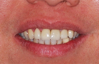 veneers 02446