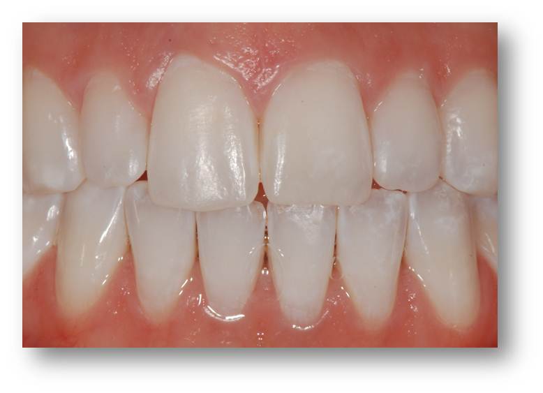 teeth whitening 02446