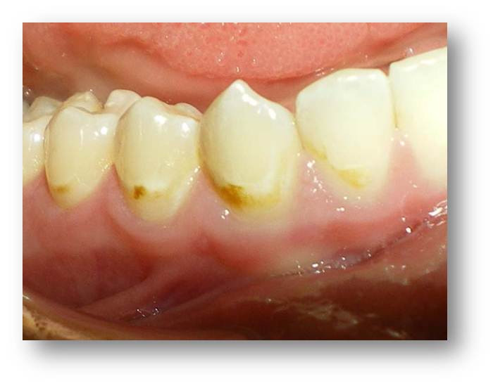 teeth whitening brookline