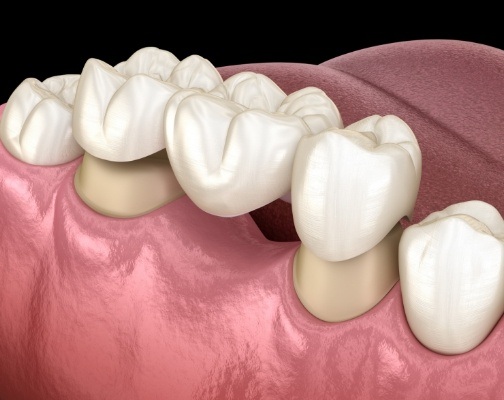 Animated dental bridge being placed in the lower arch of teeth