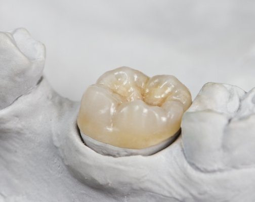 Dental crown on tooth in model of lower arch of teeth