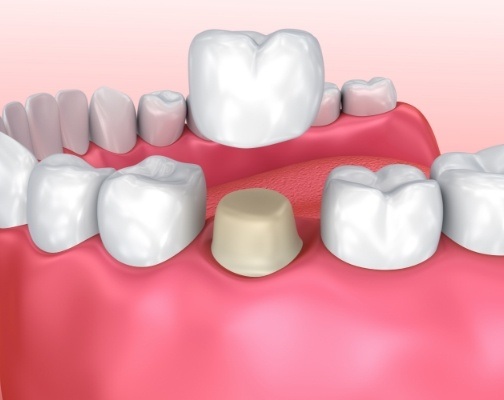 Animated dental crown being fitted over a tooth