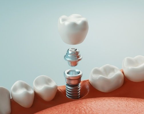 Animated dental implant being placed in the lower jaw