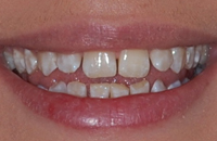 gal before