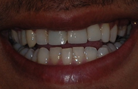 young male's smile before