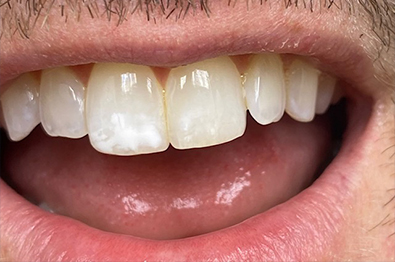 Close up of man with white spots on front teeth