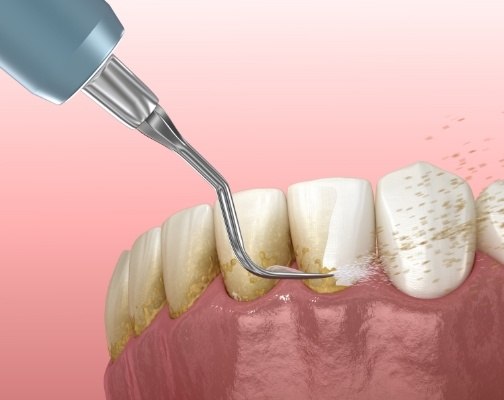 Animated dental instrument removing plaque from teeth for gum disease treatment