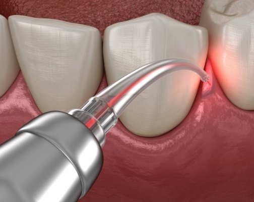 Animated laser treating gum disease