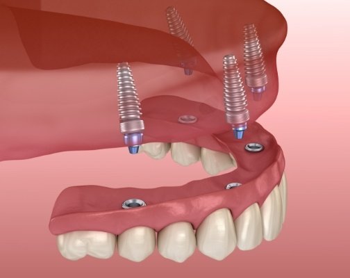 Animated implant denture being placed in upper arch of mouth