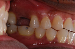 dental implants brookline