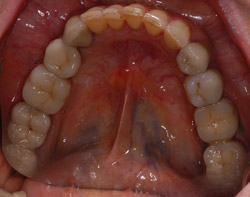 dental implants for 02446