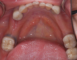 dental implants for brookline