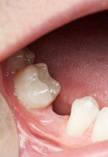 patient with gap in their smile 