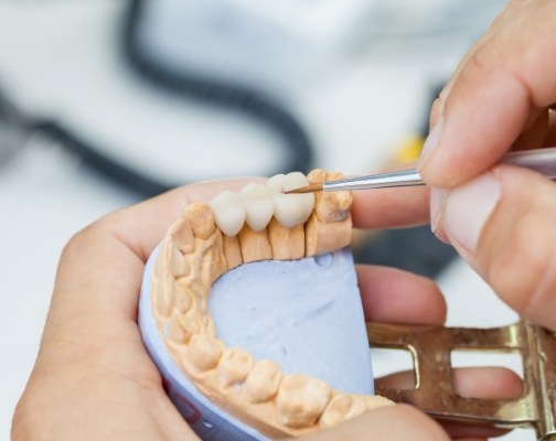Person designing a dental bridge for replacing missing teeth