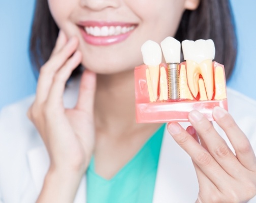 Dentist holding a model of a dental implant in the jaw