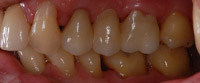 dental implants brookline