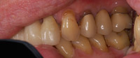 dental implants 02446