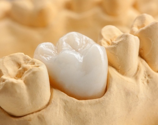 Dental crown on top of tooth in model of lower arch of teeth