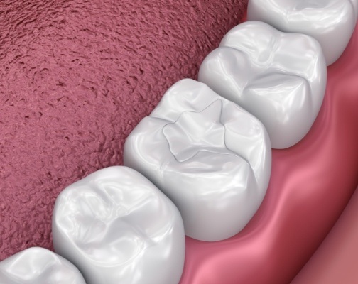 Close up of animated tooth with seamless tooth colored filling