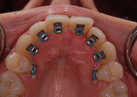 teeth with hidden braces