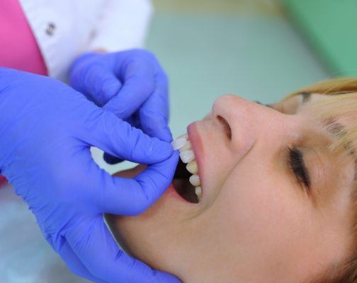 Cosmetic dentist placing a veneer on the front tooth of a patient