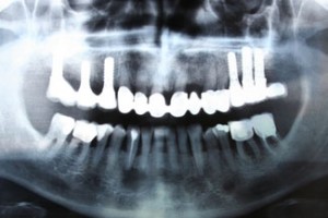 dental_implants