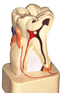 root_canal2
