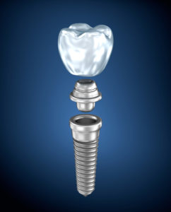 Learn about the placement procedure and recovery for dental implants in Boston.