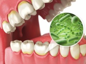 bacteria attacking gums