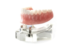dental implant model 