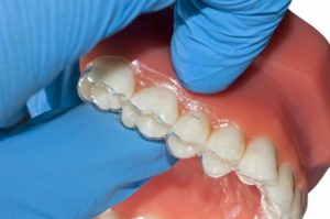 dentist placing aligners on a mouth model