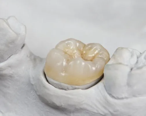 All-porcelain dental crown restoration at Boston Smile Center in Brookline MA