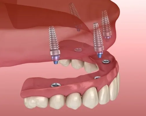 Animated implant denture being placed in upper arch of mouth