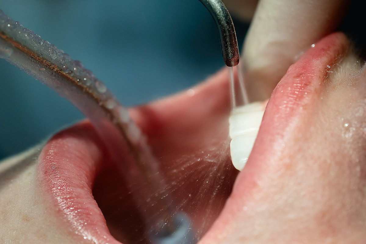 Close-up of dental cleaning process using scaler and suction tube with water spray in patient’s mouth. Concept of oral hygiene, professional dental care, and prevention.